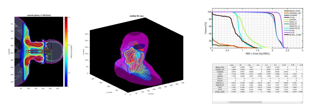 Figure 4. Visualizations generated in matRad. Left: CT and planned proton dose in the coronal plane of a head-and-neck cancer case. Center: 3D rendering of the same visualization. Right: Sample dose histograms and statistics tables.