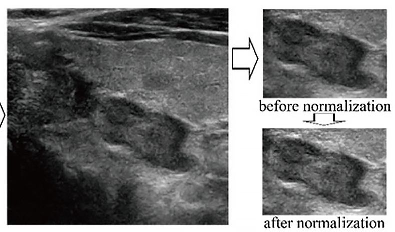 Image captures of nodules showing an example of normalization performed on a region of interest. The nodules are shown before and after normalization.