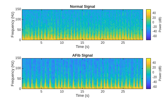 Classify ECG Signals Using Long Short-Term Memory Networks