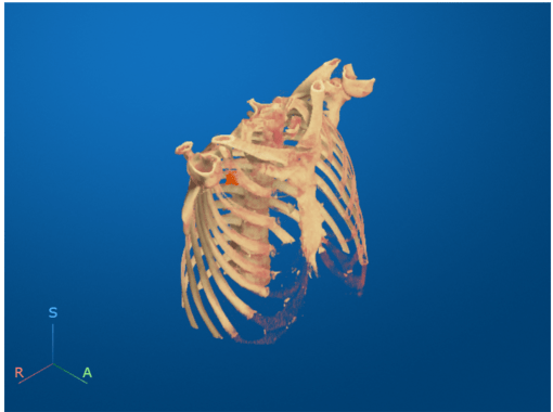 Chest CT display after bed removal