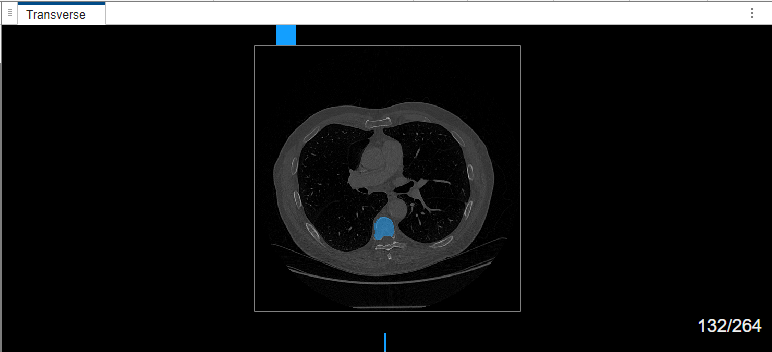 MedSAM segmentation in transverse view