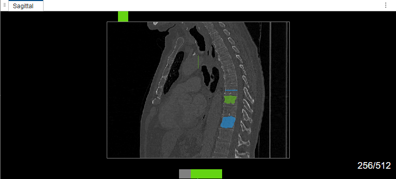 MedSAM segmentation in sagittal view