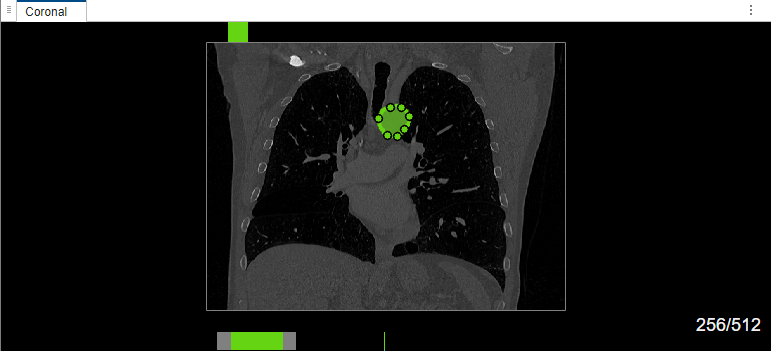 Edit labels created using MedSAM in coronal view