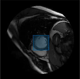 MedSAM bounding box