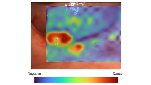 Advancing Real-Time Cancer Diagnosis with AI